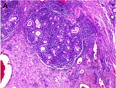 ESMG with ductal metaplasia and inflammation