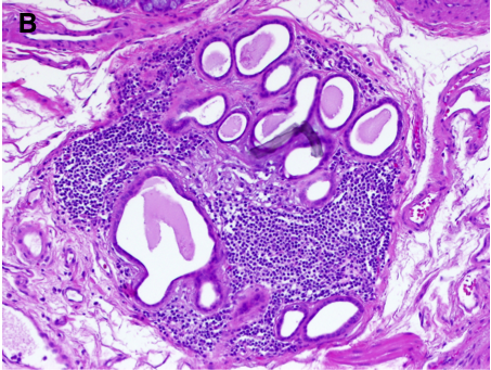 ESMG with ductal metaplasia and inflammation