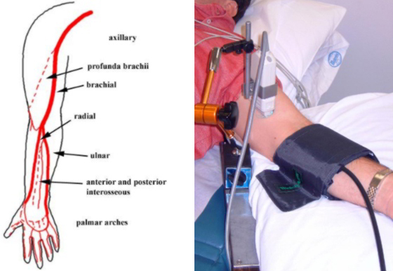 Brachial Artery Flow-Mediated Dilation