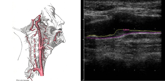 Carotid intimal-medial thickness