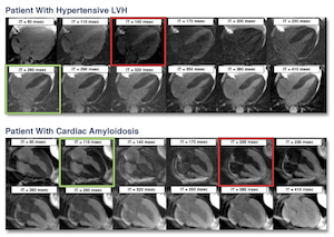 Imaging for patient with hypertensive LVH