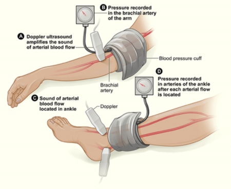 Doppler Ankle-Brachial Index (ABI)