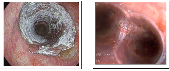 Complex Airway Disorders