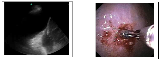 Pleural Disease