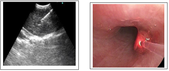 Thoracic Oncology