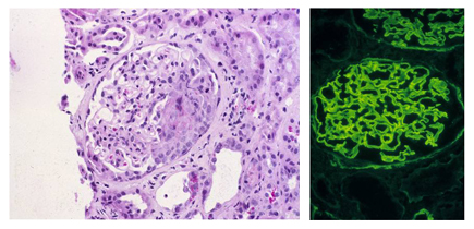 Goodpasture Syndrome (GPS) and anti-GBM Nephritis image