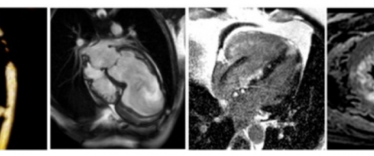 Cardiac MRI example