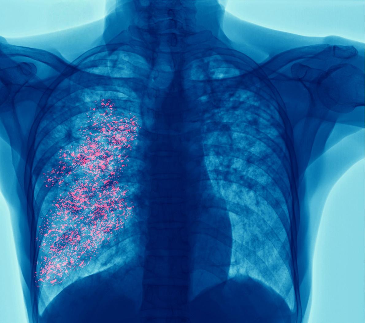 X-ray chest showing cavity at right lung and interstitial infiltrate both lung due to TB infection, Pulmonary tuberculosis stock photo